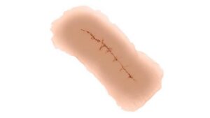 Klebende Wundversorgung für Inzisionen – 12-teilige Mischpackung